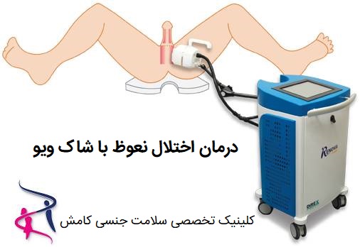 شاک ویو تراپی آلت و درمان اختلال نعوظ با شاک ویو در تهران