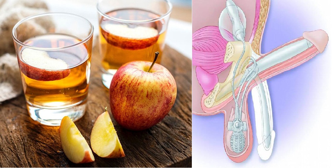 درمان طبیعی و گیاهی اختلال نعوظ با سرکه سیب بعنوان یک راست کننده