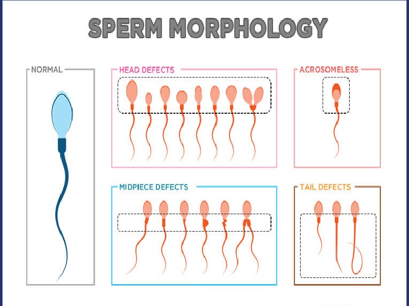 آیا مورفولوژی اسپرم  بر باروری تأثیر می گذارد؟