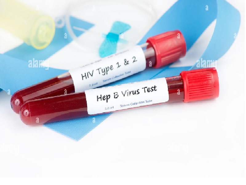 عفونت همزمان هپاتیت در افراد مبتلا به HIV