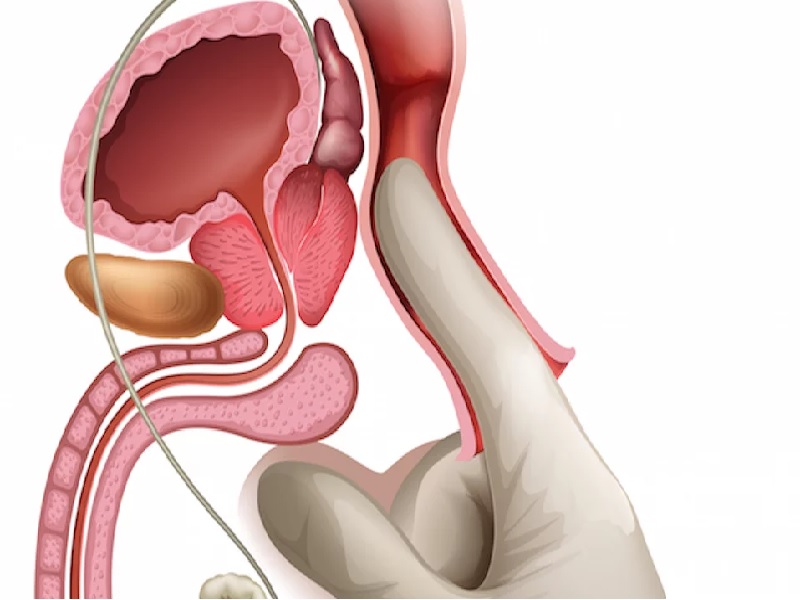 یزرگ شدن پروستات : راهنمای جامع بیماری ها و روش های درمان 