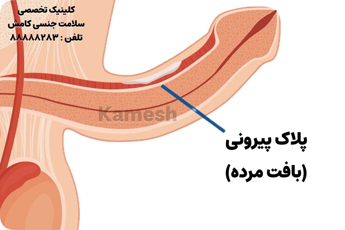 کجی آلت یا پلاک پیرونی چیست