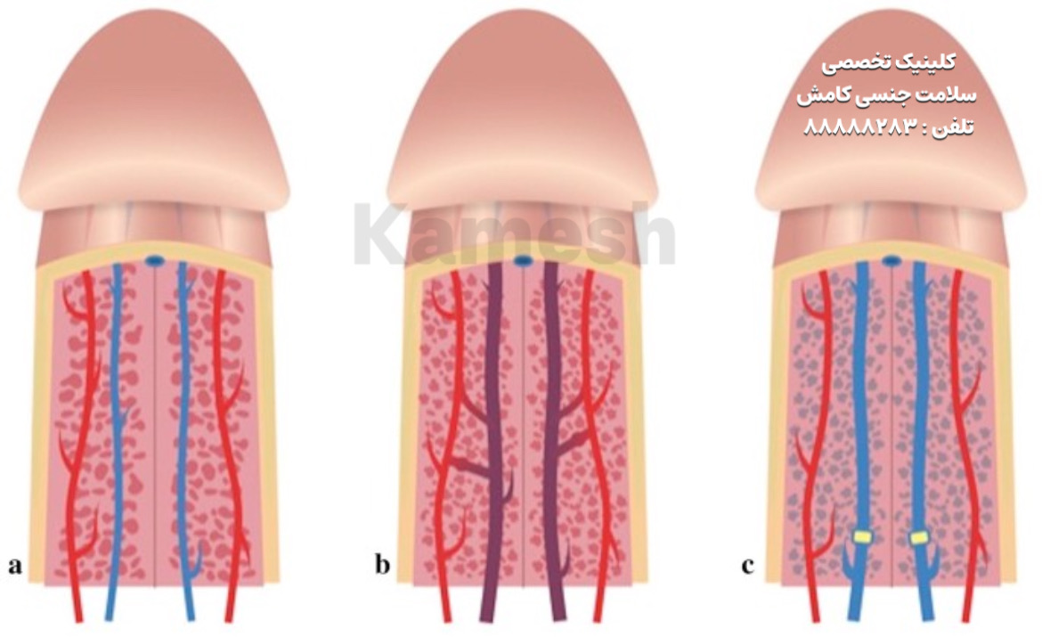 علائم ، تشخیص و درمان نعوظ دائم یا پریاپیسم 
