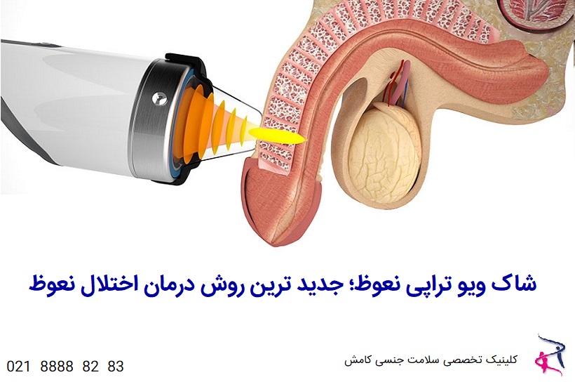 شاک ویو تراپی نعوظ در تهران + هزینه درمان اختلال نعوظ با شاک ویو