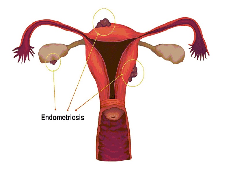 رابطه زناشویی در آندومتریوز 